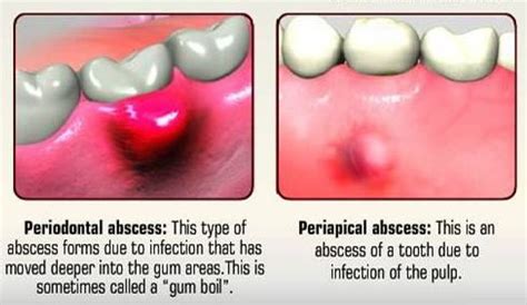Kid With Abscess On Gum Periostitis Gum Abscesses Remedies You