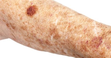 Age Spot Or Skin Cancer Pictures Photos