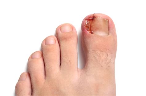 Ingrown Toenails What Are They And How We Treat The Healthcare Hub