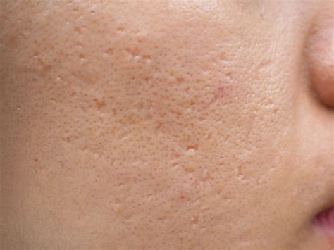 10 Acne Scar Treatments Recommended By Top Dermatologist Adm Skincare