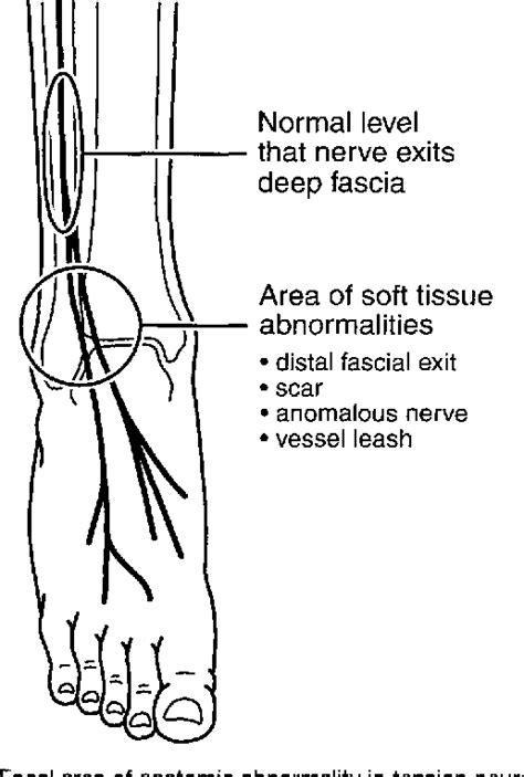 Tension Neuropathy Of The Superficial Peroneal Nerve Associated