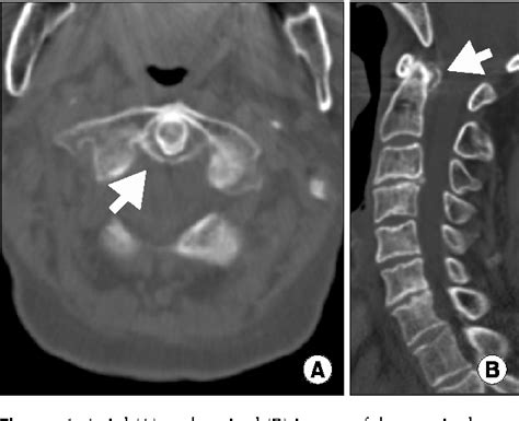 Figure 1 From Acute Pseudogout Of The Neck Crowned Dens Revisited