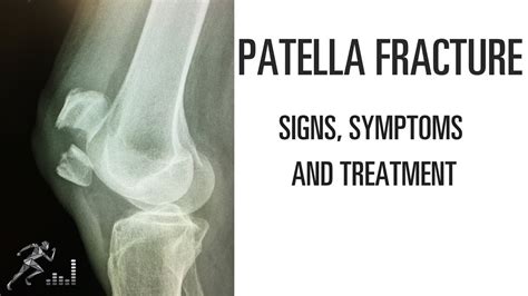 Patella Fracture Types