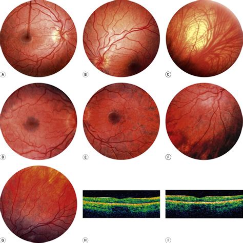 Heredodystrophic Disorders Affecting The Pigment Epithelium And Retina