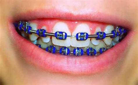 How To Choose Good Brace Colors That Best Suits You Ivanov Orthodontic Braces Colors Cute