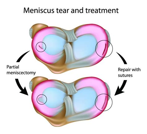 Can You Play Sports After Surgery For A Meniscus Tear Dr Geier