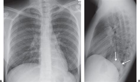 Pneumonia Lateral Chest X Ray Pneumonia 2020