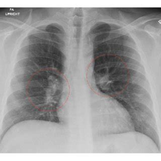 Chest X Ray PA Upright Showing Bilateral Hilar Lymphadenopathy