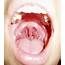 Uvula Causes Symptoms Treatment