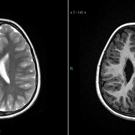 Anatomy Of Medial Temporal Lobe Download Scientific Diagram