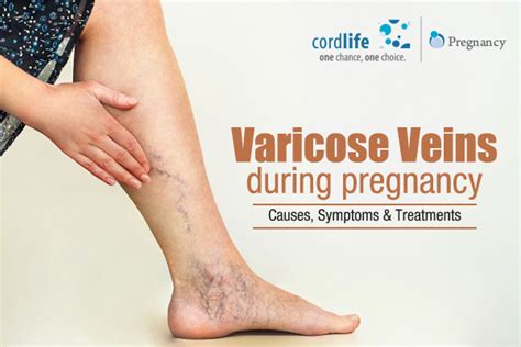 Varicose Veins In Pregnancy Causes Symptoms Treatments