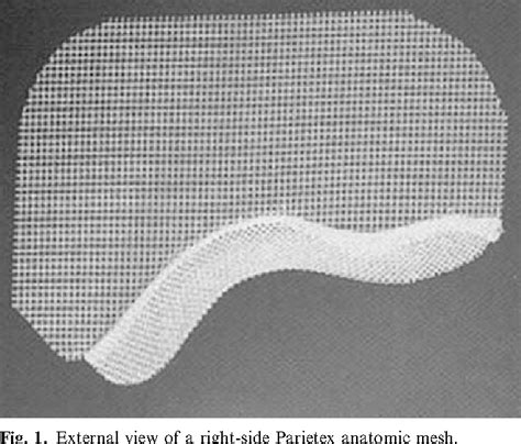 Figure 1 From Polyester Parietex Mesh For Total Extraperitoneal