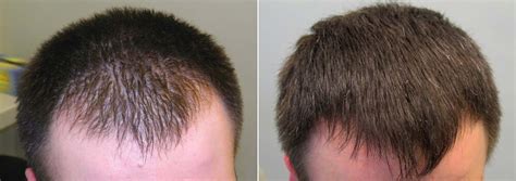 Finasteride Before And After Photos 2023