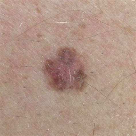 How To Spot Skin Cancer On Arm Cancerwalls