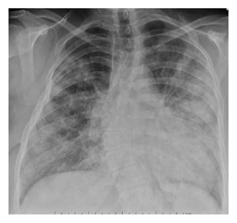 Showing The Chest Radiograph Posteroanterior View The Cardiac