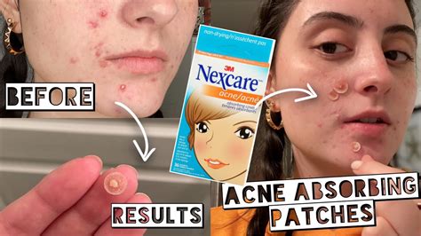 Testing Nexcare Acne Absorbing Patches For My Acne Hydrocolloid