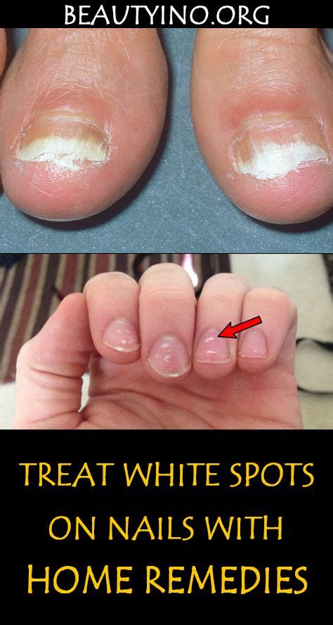 Treat White Spots On Nails With Home Remedies In 2020 White Spots On