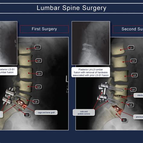 Lumbar Spine Surgery Trialexhibits Inc