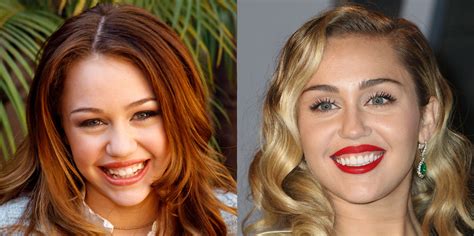 Hilary Duff Teeth Before And After