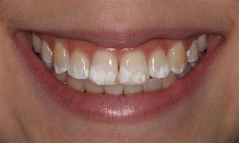 Ohana Dental Nj Smile Gallery Icon White Spot Removal