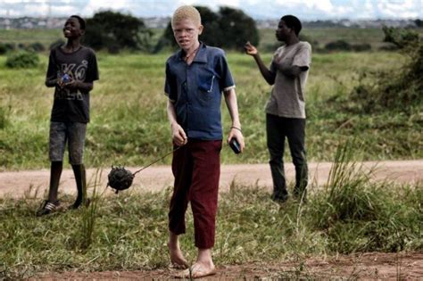 Albinos In Malawi Hunted And Killed For Their Body Parts