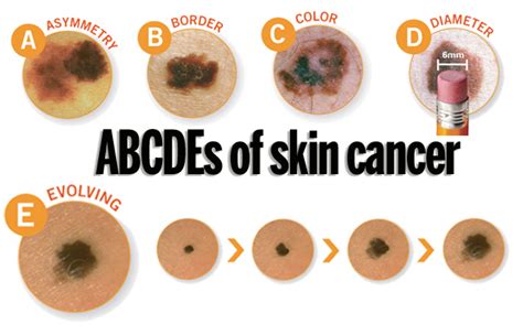 Dermatologists Urge People To Learn The Abcdes Of Skin Cancer The