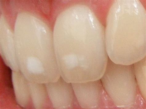 White Spots On Kids Teeth