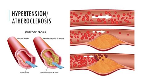 How Does High Blood Pressure Affect Atherosclerosis Liv Healthy Life