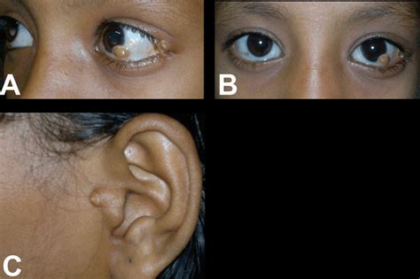 A B The Patient Showing Left Limbal Dermoid Cyst Dermal Tag At The