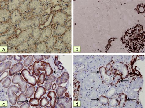 Expression of ß catenin and vimentin in renal graft A very thin