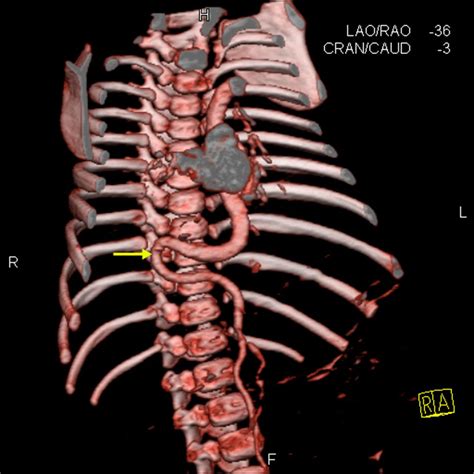 Arterial Tortuosity Syndrome Bmj Case Reports
