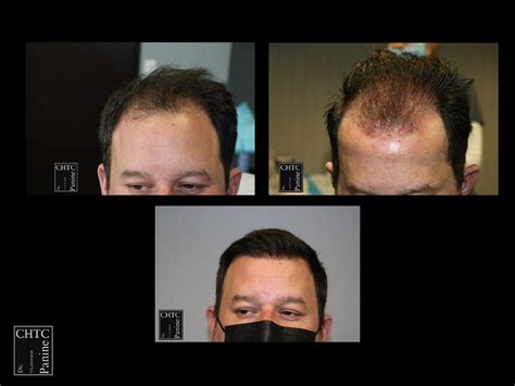 Panine Md Chicago Hair Transplant Clinic Fue Hair Transplant