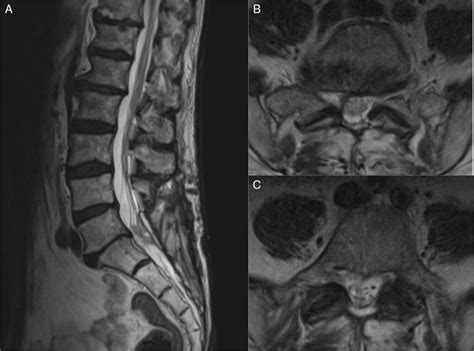 Intradural Metastasis From Cutaneous Squamous Cell Carcinoma Causing