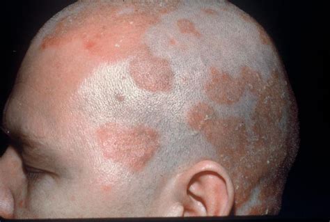 Seborrheic Dermatitis Skin Condition