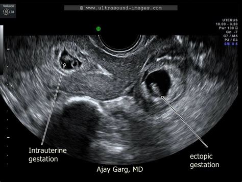 Ultrasound Images Of Early Pregnancy