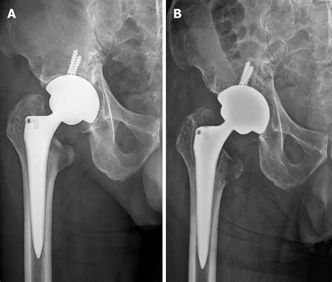 Screw Penetration Of The Iliopsoas Muscle Causing Late Onset Pain After