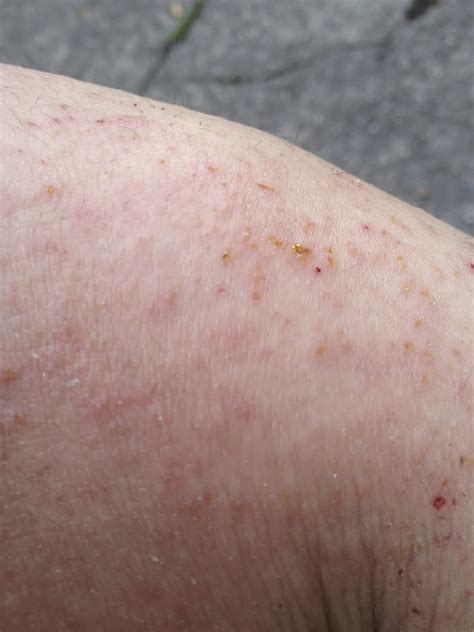 My Journey With Itchy Skin Snippet Of Photos Over Time