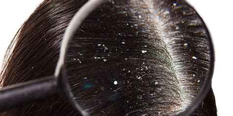 4 Types Of Dandruff And How To Treat Them