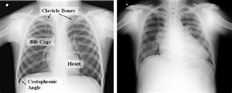 The sternoclavicular joint (sc joint) is formed from the articulation of the medial aspect of the clavicle and the manubrium of the sternum. Anatomical features in two chest X-ray images and their ...