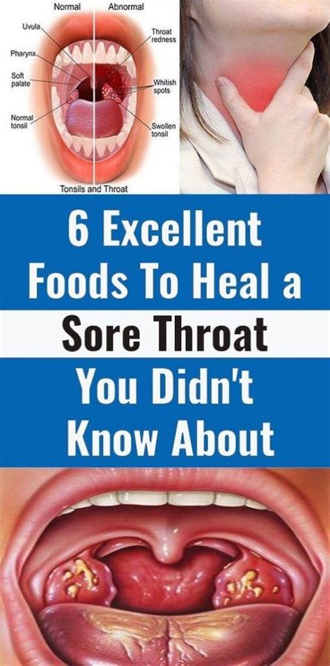 6 Foods That Can Help You Heal Sore Throat Heal Sore Throat Sore