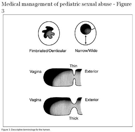 Medical Management Of Pediatric Sexual Abuse British Columbia Medical Journal
