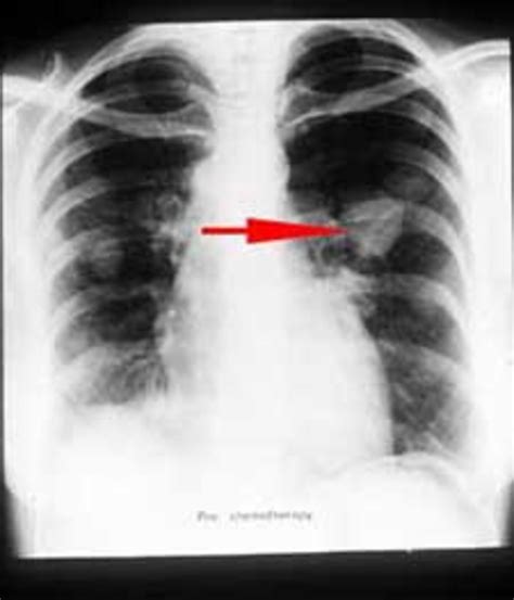Normally, cancer cells may break away from the tumor and travel through the lymph system, blood circulation and invade the brain. Radiographic Representation Of Lung Cyst (Lung Cancer ...