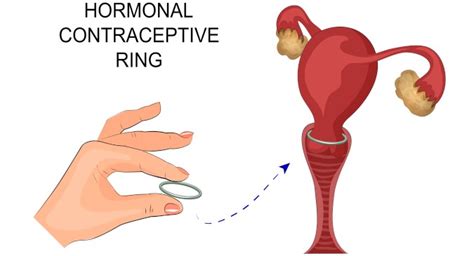 world contraception day 2017 everything you wanted to know about the vaginal ring nuvaring