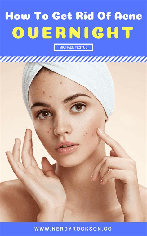 How To Get Rid Of Acne Overnight Home Remedies For Acne Acne