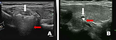 Frontiers Pharyngoesophageal Diverticulum Mimicking Thyroid Nodules