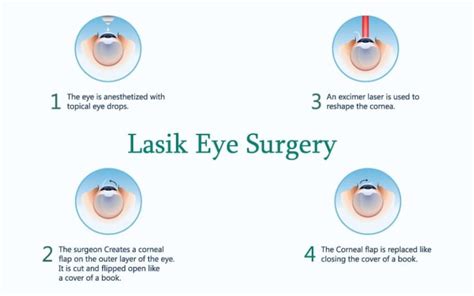 top 4 benefits and top 4 risks of lasik surgery mymeditravel knowledge