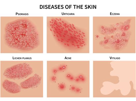 Skin Disorders Archives Medical Referral