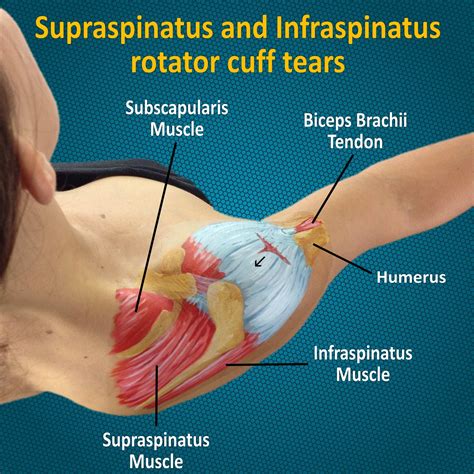 Supraspinatus And Infraspinatus Rotator Cuff Tears Rotator Cuff Subscapularis Muscle Rotator