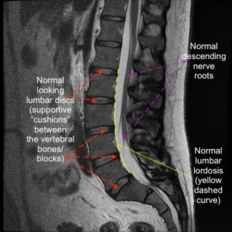 Normal Versus Abnormal Lumbar Anatomy Cns Neurosurgery