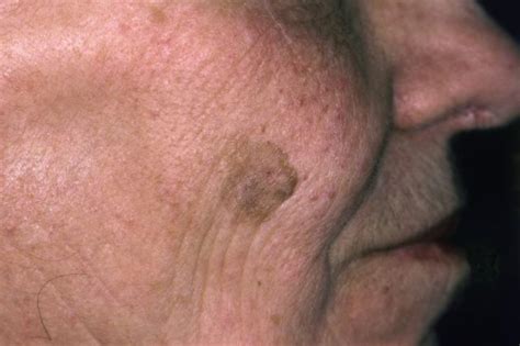 Eskata Now Available To Treat Raised Seborrheic Keratoses Dermatology